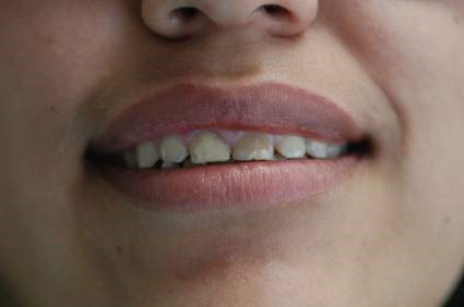 Cosmetic Dentist in Olmos Park